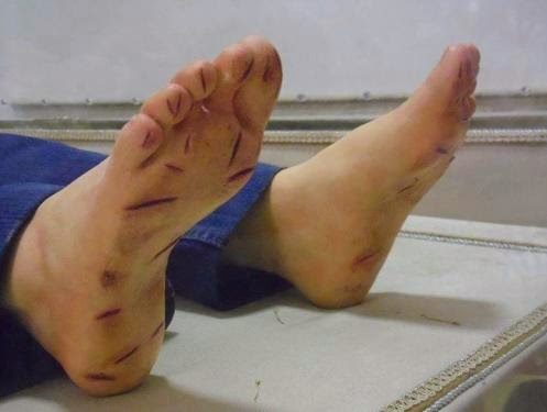 tortured feet of bl jose